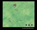 mycobacterium tuberculosis in sputum, Z-N